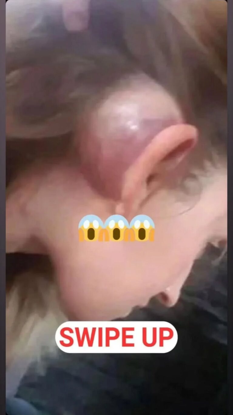 What’s Causing This Cyst?